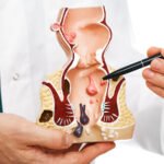How to Find the Best Hemorrhoids Doctor Near You: A Complete Guide